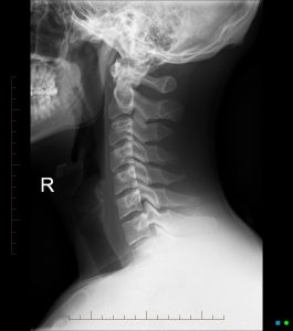 Near Normal Spine